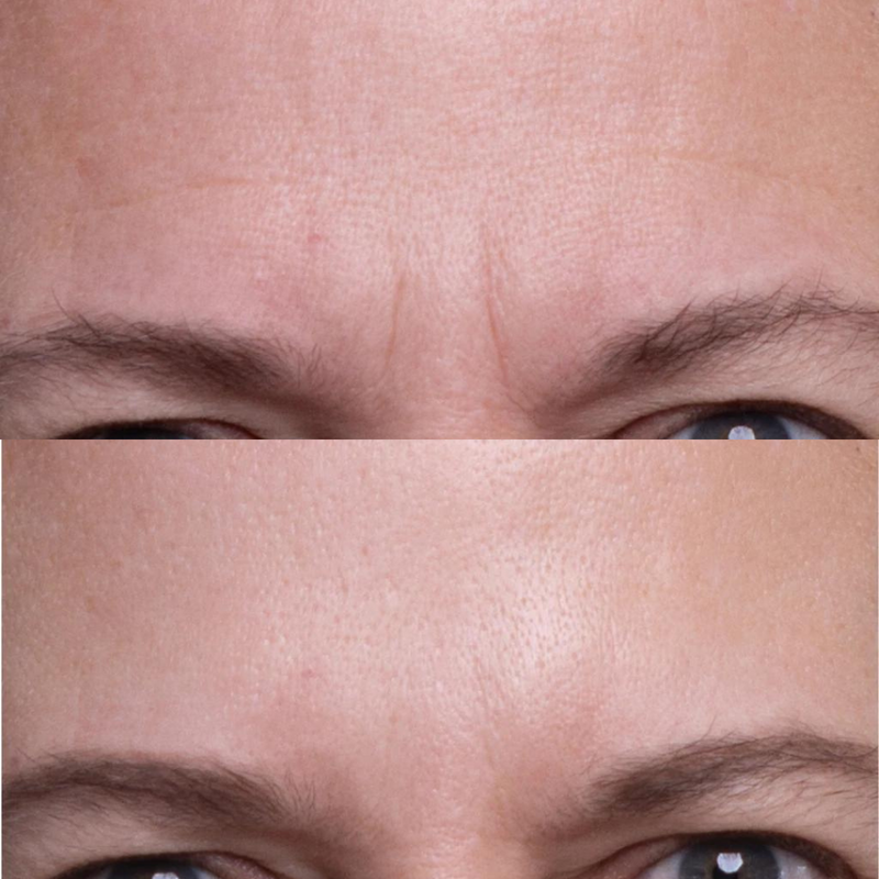 Wrinkles Schminkles Forehead Wrinkle Patch